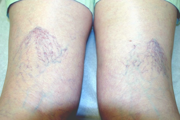 Причина появления сетки на ногах лечение thumbnail