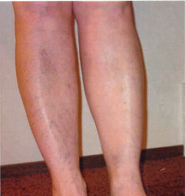 На ногах появились вены в виде сетки лечение народными средствами thumbnail