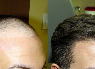 Пересадка волос в Москве Пересадка волос в Москве