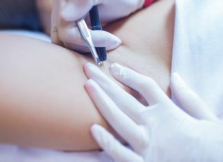 Электроэпиляция Электроэпиляция