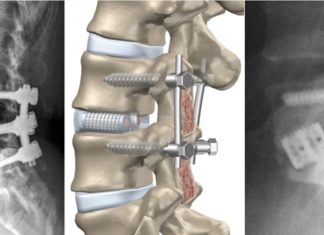 Декомпрессия позвоночника: что это, зачем она нужна Декомпрессия позвоночника: что это, зачем она нужна