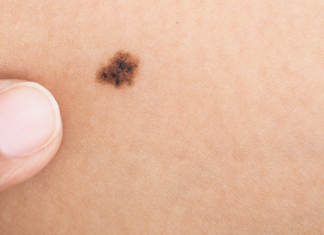 Меланома: что это такое, почему данное онкологическое заболевание нужно лечить, к какому врачу обратится, как диагностировать Меланома: что это такое, почему данное онкологическое заболевание нужно лечить, к какому врачу обратится, как диагностировать