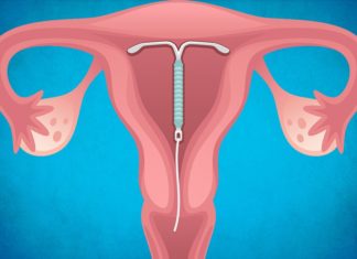 Противозачаточная спираль: для чего нужна: как вводится врачом, насколько ее хватает, преимущества и недостатки, нужно ли принимать дополнительные лекарства? Противозачаточная спираль: для чего нужна: как вводится врачом, насколько ее хватает, преимущества и недостатки, нужно ли принимать дополнительные лекарства?