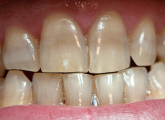 Флюороз — страшный зверь? Причины, симптомы, лечение Флюороз - страшный зверь? Причины, симптомы, лечение