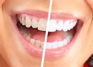 Безопасно ли отбеливание зубов? Безопасно ли отбеливание зубов?