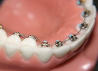 Лингвальные брекеты: что это такое, виды, кому подходят, особенности и преимущества