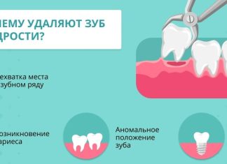 Что нужно знать о процедуре удаления зубов