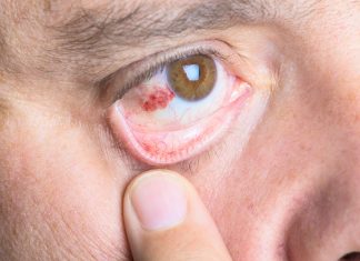 Геморрагический синдром – редко, но метко!