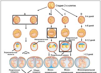 Многоплодная беременность: монохориальная и дихориальная двойня
