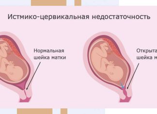 Невынашивание беременности: первичное и привычное, почему происходит самопроизвольное прерывание беременности — узнайте в Клинике МЕДСИ