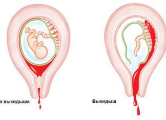 Невынашивание беременности: причины, симптомы и лечение в статье гинеколога Симанина С. В.