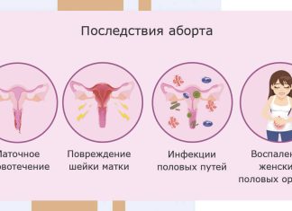 Осложнения(последствия) аборта — как избежать