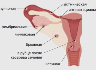 Причины внематочной беременности | EUROLAB | Гинекология