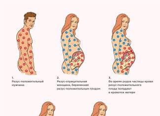 Резус-конфликт при беременности: причины возникновения, лечить или наблюдать?