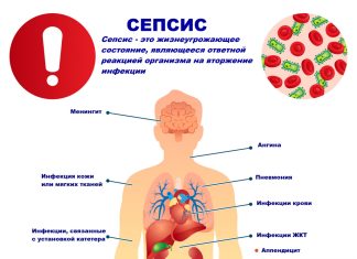 Сепсис — причины появления, симптомы заболевания, диагностика и способы лечения