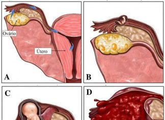 Симптомы внематочной беременности, признаки, как определить — в статье гинеколога Климанова А. Ю.