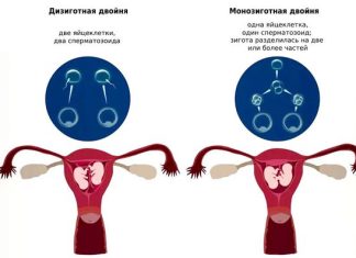 Токсикоз беременных: причины, симптомы и лечение в статье гинеколога Карагулян О. Р.