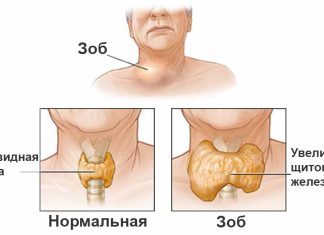 Узловой зоб при беременности — симптомы болезни, профилактика и лечение Узлового зоба при беременности, причины заболевания и его диагностика на EUROLAB
